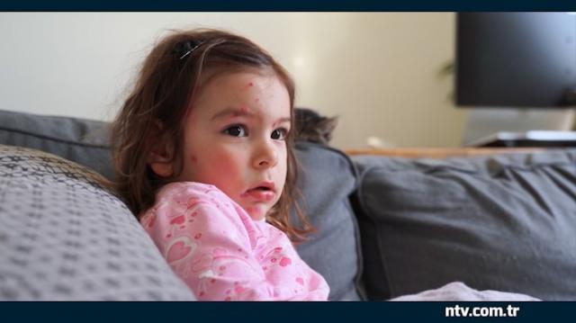 Unutulan hastalık geri mi dönüyor? İstanbul'da vaka sayılarında artış